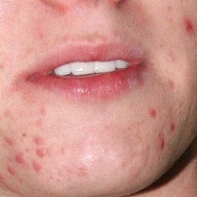 Pimples Pictures